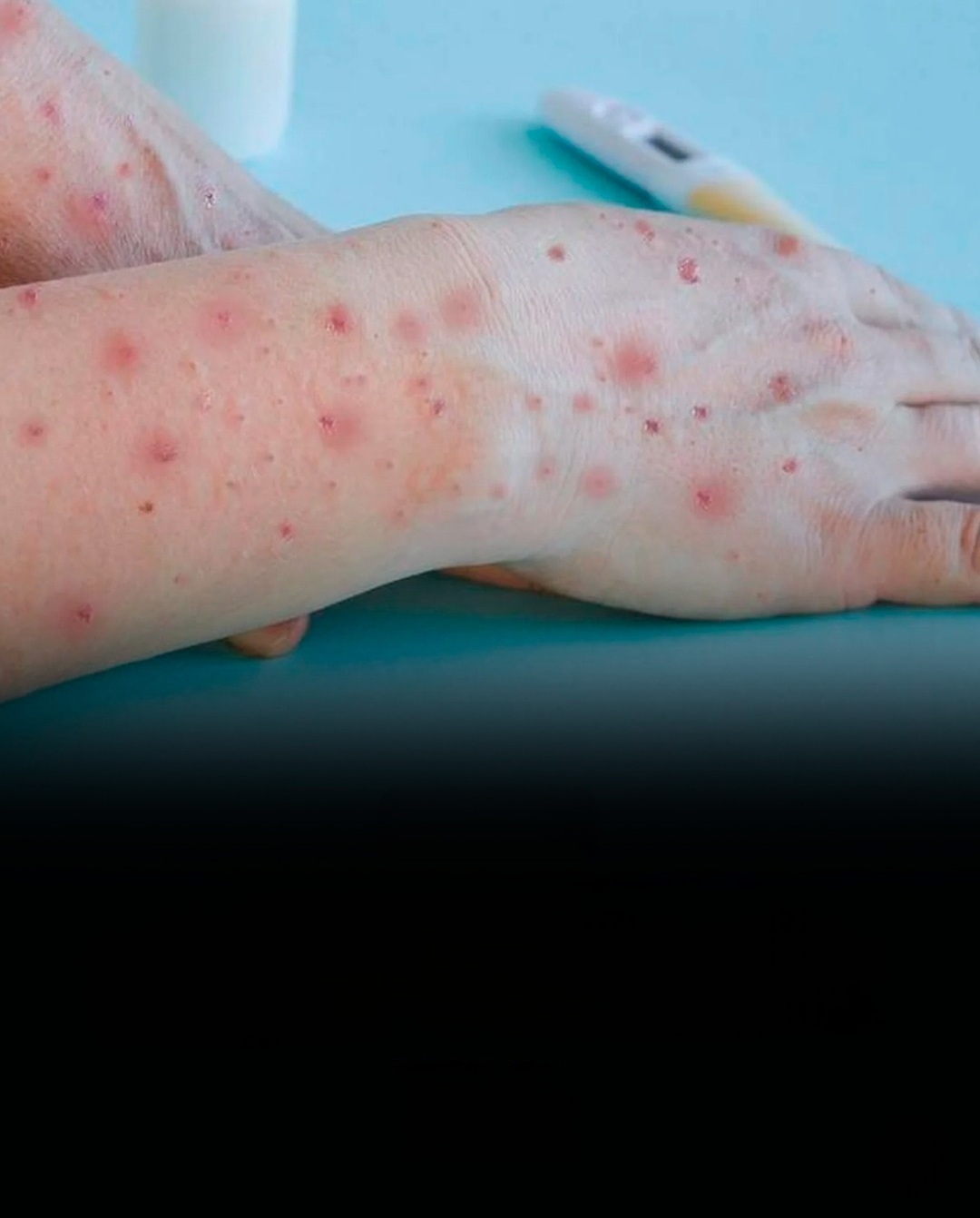Moradora da Grande São Paulo é o primeiro caso da nova cepa Mpox no Brasil