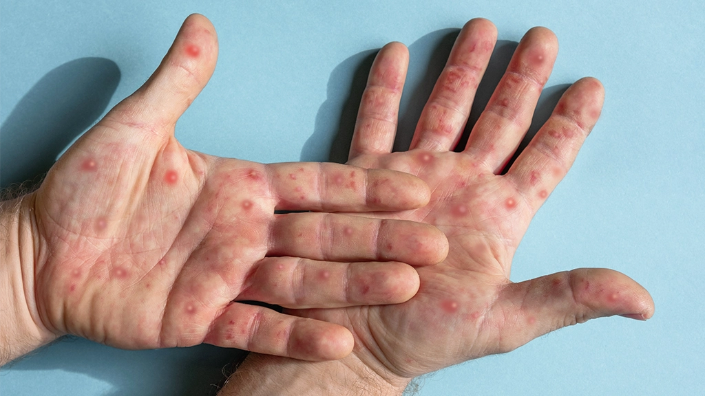 Brasil registra 88 casos de Mpox em 2026; saiba como evitar a doença