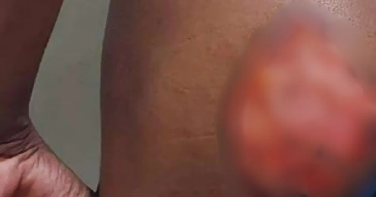 Jovem negro com deficiência auditiva é marcado por ferro no Sudoeste baiano; irmãos são presos